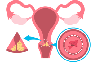 Zervikale intraepitheliale Neoplasie (CIN)