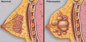 Mastopathie ist eine Erkrankung der Brustdrüse, die durch die Bildung von Zysten und fibrotischen Veränderungen im Brustgewebe gekennzeichnet ist. Diese Veränderungen können fibrozystische Bereiche, fibrotische Knoten oder Zysten umfassen. Dieser Zustand betrifft viele Frauen und kann verschiedene Symptome wie Schmerzen, Empfindlichkeit und unangenehme Veränderungen an den Brüsten verursachen. Indol-3-Carbinol ist bei der Behandlung von Mastopathie nützlich, da es hilft, das hormonelle Gleichgewicht zu erhalten und somit die Wahrscheinlichkeit fibrozystischer Veränderungen in den Brüsten verringert.